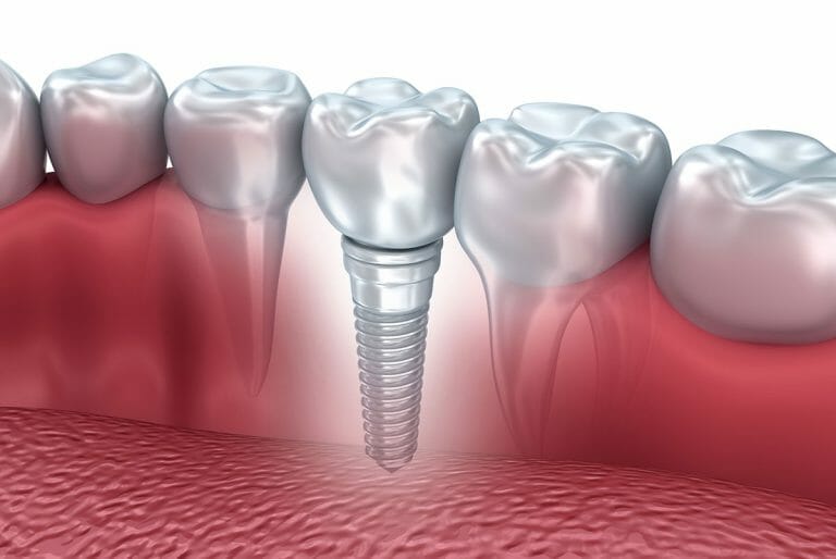 Implant dentaire : peut-on avoir à faire à un échec ?