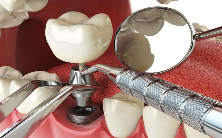 Implant dentaire : pourquoi chaque implant à la forme de la dent ?